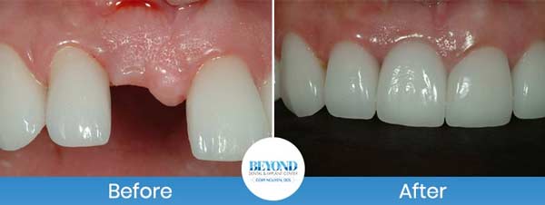 Single and Multiple Teeth Implants Service in Los Altos, CA