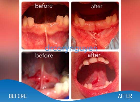 Tongue Tie Surgery Before and After Photos of Patients in Los Altos, CA Tongue Tie Surgery Before and After Photos of Patients in Los Altos, CA