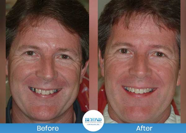 Orthodontics Smile Gallery Near Me in Los Altos, CA