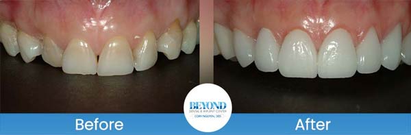 Porcelain Veneers Smile Gallery Near Me in Los Altos, CA