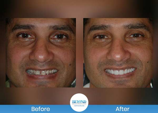 Smile Makeover Gallery in Los Altos, CA