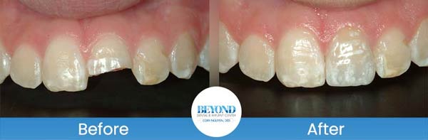 Porcelain Veneers Smile Gallery Near Me in Los Altos, CA