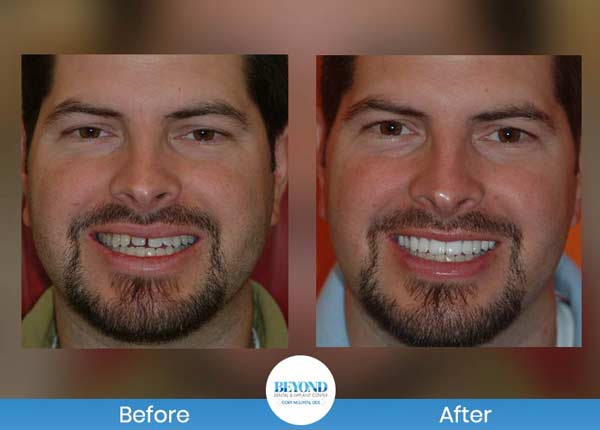 Smile Makeover Gallery in Los Altos, CA