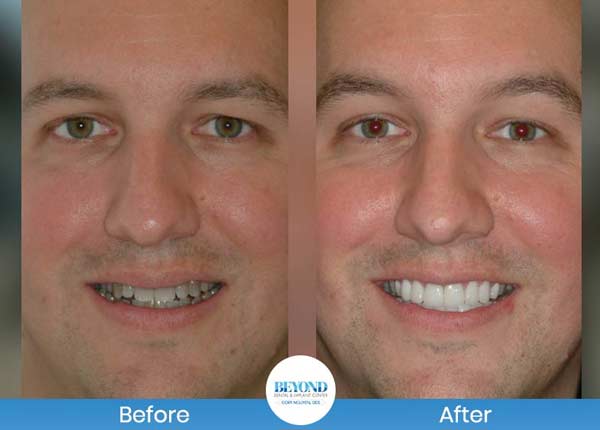 Smile Makeover Gallery in Los Altos, CA