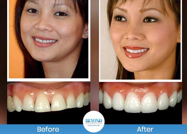 Smile Makeover Gallery in Los Altos, CA