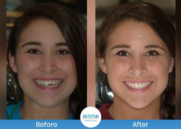 Smile Makeover Gallery in Los Altos, CA