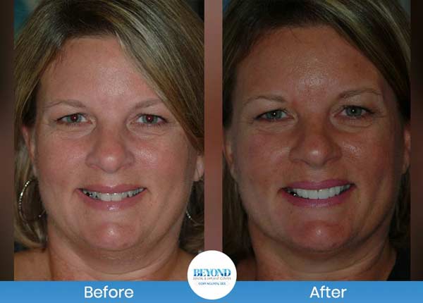 Smile Makeover Gallery in Los Altos, CA