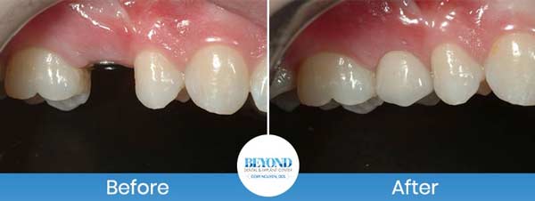 Single and Multiple Teeth Implants Service in Los Altos, CA