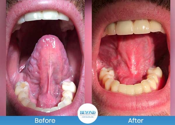 Tongue Tie Surgery Before and After Photos of Patients in Los Altos, CA Tongue Tie Surgery Before and After Photos of Patients in Los Altos, CA
