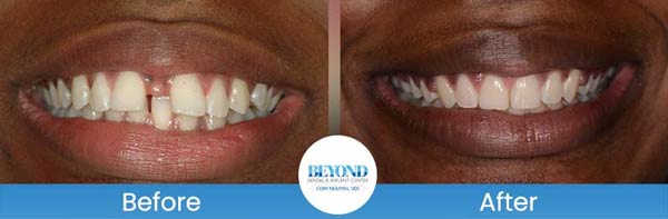 Orthodontics Smile Gallery Near Me in Los Altos, CA