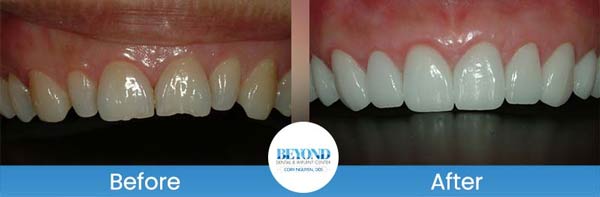 Porcelain Veneers Smile Gallery Near Me in Los Altos, CA