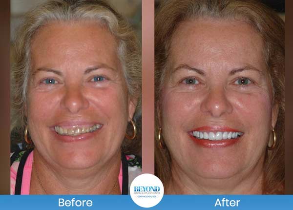 Smile Makeover Gallery in Los Altos, CA