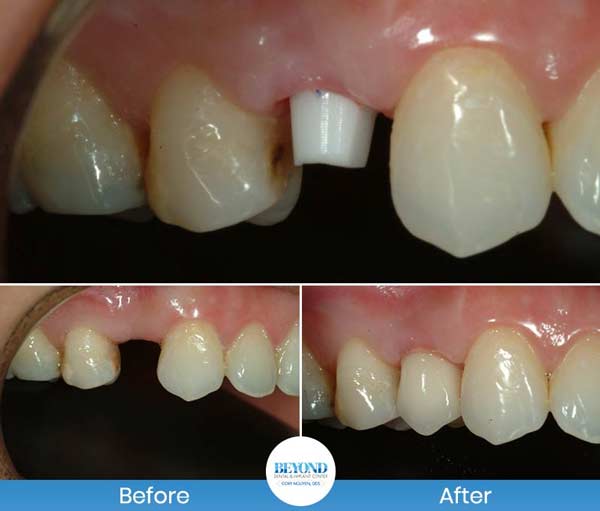 Single and Multiple Teeth Implants Service in Los Altos, CA