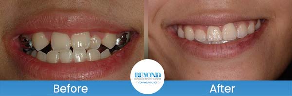 Orthodontics Smile Gallery Near Me in Los Altos, CA