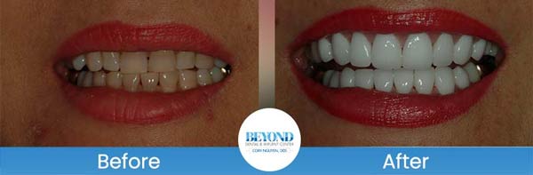 Porcelain Veneers Smile Gallery Near Me in Los Altos, CA