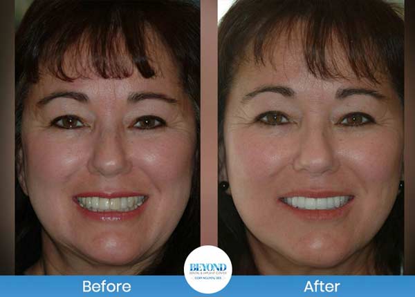 Smile Makeover Gallery in Los Altos, CA