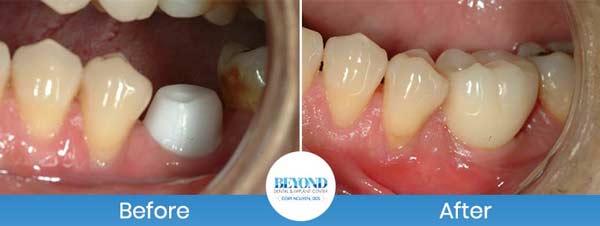 Single and Multiple Teeth Implants Service in Los Altos, CA