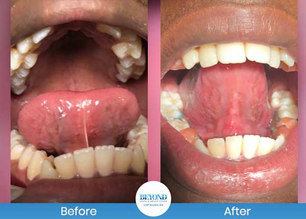 Tongue Tie Surgery Before and After Photos of Patients in Los Altos, CA Tongue Tie Surgery Before and After Photos of Patients in Los Altos, CA