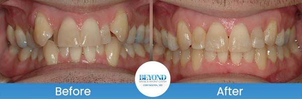 Orthodontics Smile Gallery Near Me in Los Altos, CA