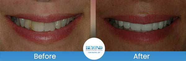 Porcelain Veneers Smile Gallery Near Me in Los Altos, CA