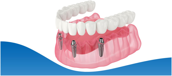 All-on-4 Dental Implants Near Me in Los Altos, CA All-on-4 Dental Implants Near Me in Los Altos, CA