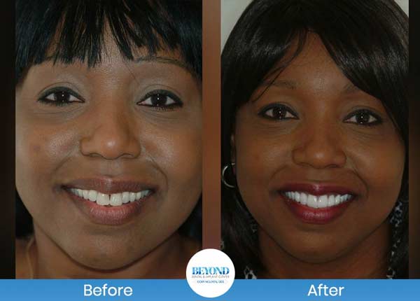 Smile Makeover Gallery in Los Altos, CA