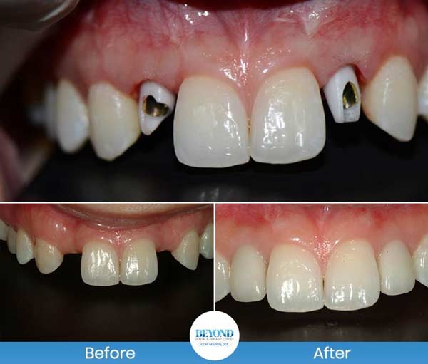 Single and Multiple Teeth Implants Service in Los Altos, CA