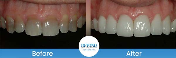 Porcelain Veneers Smile Gallery Near Me in Los Altos, CA