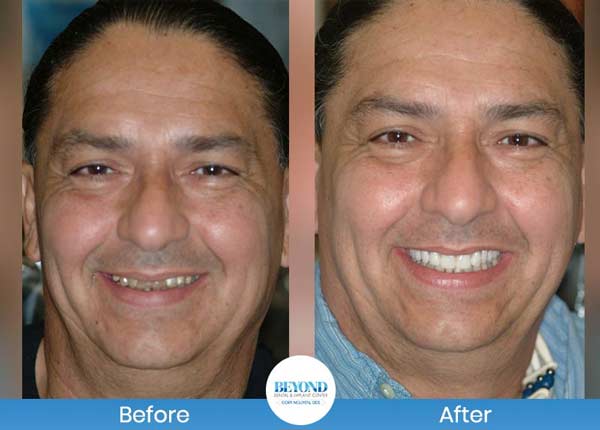 Smile Makeover Gallery in Los Altos, CA