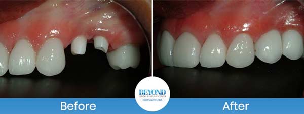 Single and Multiple Teeth Implants Service in Los Altos, CA