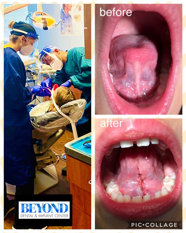 Tongue Tie Surgery Before and After Photos of Patients in Los Altos, CA Tongue Tie Surgery Before and After Photos of Patients in Los Altos, CA