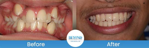 Orthodontics Smile Gallery Near Me in Los Altos, CA