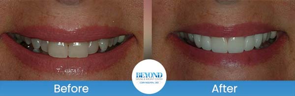 Porcelain Veneers Smile Gallery Near Me in Los Altos, CA