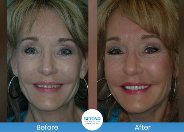 Smile Makeover Gallery in Los Altos, CA