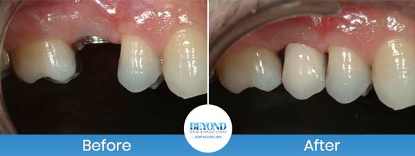 Single and Multiple Teeth Implants Service in Los Altos, CA