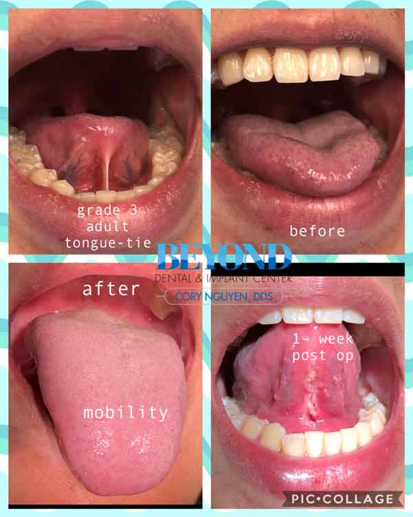 Tongue Tie Surgery Before and After Photos of Patients in Los Altos, CA Tongue Tie Surgery Before and After Photos of Patients in Los Altos, CA