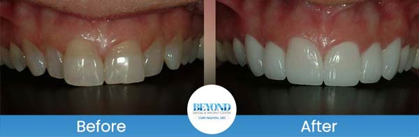 Porcelain Veneers Smile Gallery Near Me in Los Altos, CA