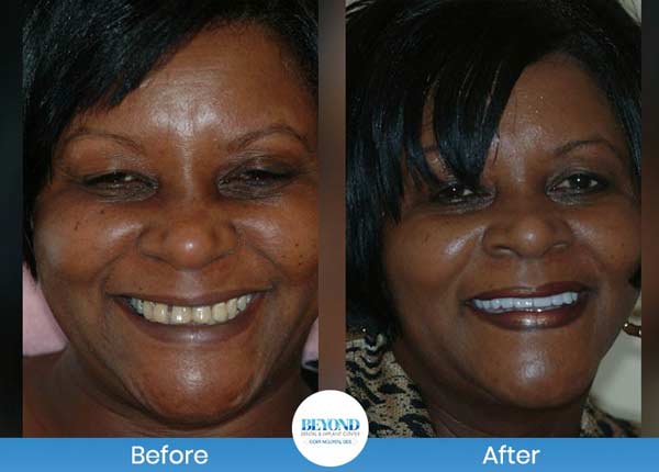 Smile Makeover Gallery in Los Altos, CA