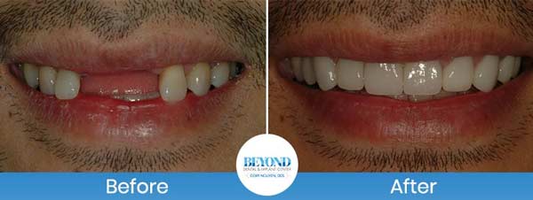 Single and Multiple Teeth Implants Service in Los Altos, CA