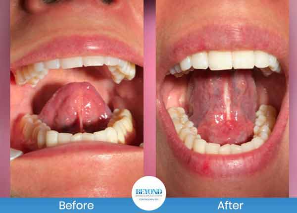 Tongue Tie Surgery Before and After Photos of Patients in Los Altos, CA Tongue Tie Surgery Before and After Photos of Patients in Los Altos, CA