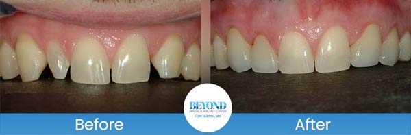 Porcelain Veneers Smile Gallery Near Me in Los Altos, CA