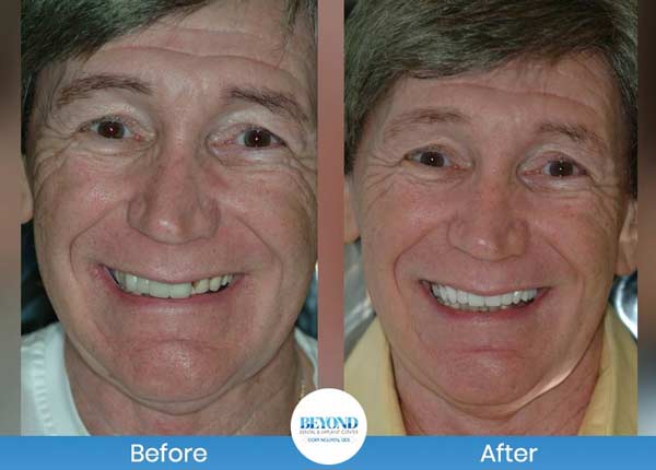 Smile Makeover Gallery in Los Altos, CA