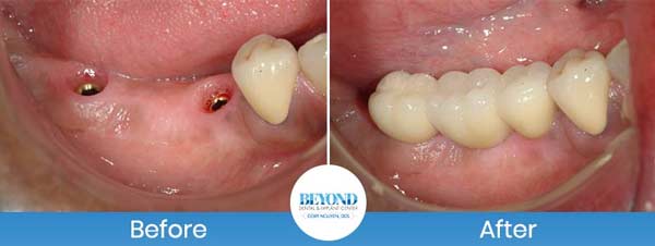 Single and Multiple Teeth Implants Service in Los Altos, CA