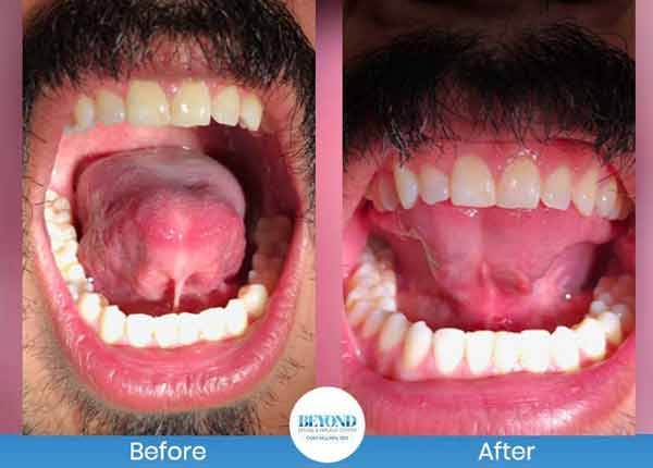 Tongue Tie Surgery Before and After Photos of Patients in Los Altos, CA Tongue Tie Surgery Before and After Photos of Patients in Los Altos, CA