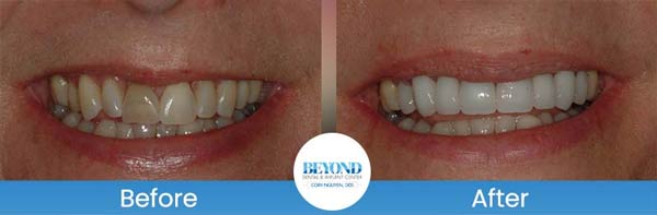 Porcelain Veneers Smile Gallery Near Me in Los Altos, CA