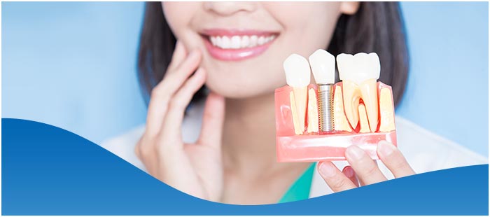 Affordable Dental Implants Near Me in Los Altos, CA Affordable Dental Implants Near Me in Los Altos, CA