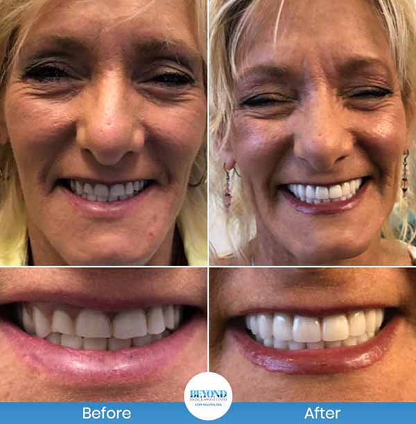 Smile Makeover Gallery in Los Altos, CA