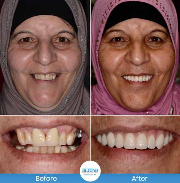 Smile Makeover Gallery in Los Altos, CA