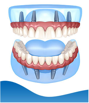 All-On-4 Dental Implants Near Me in Los Altos, CA