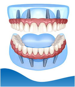 All-On-4 Dental Implants Near Me in Los Altos, CA